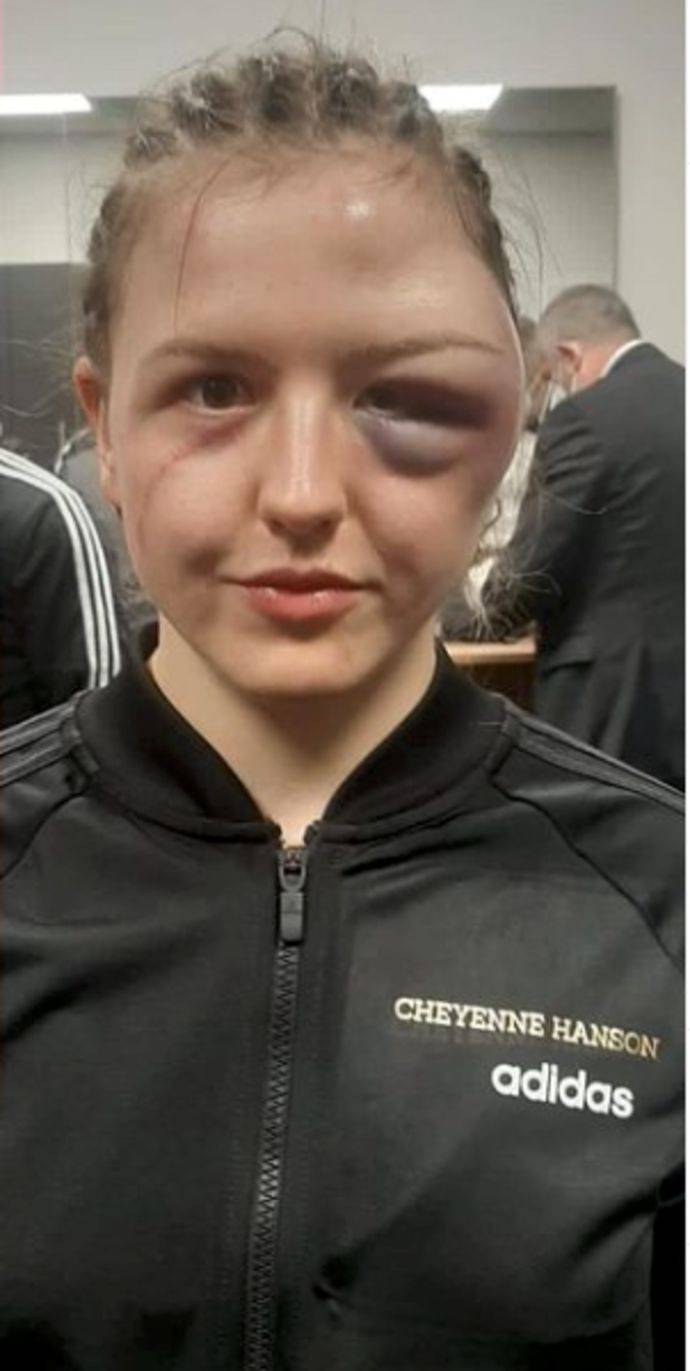 Boxing injury: Cheyenne Hanson shows off horrific swollen face damage