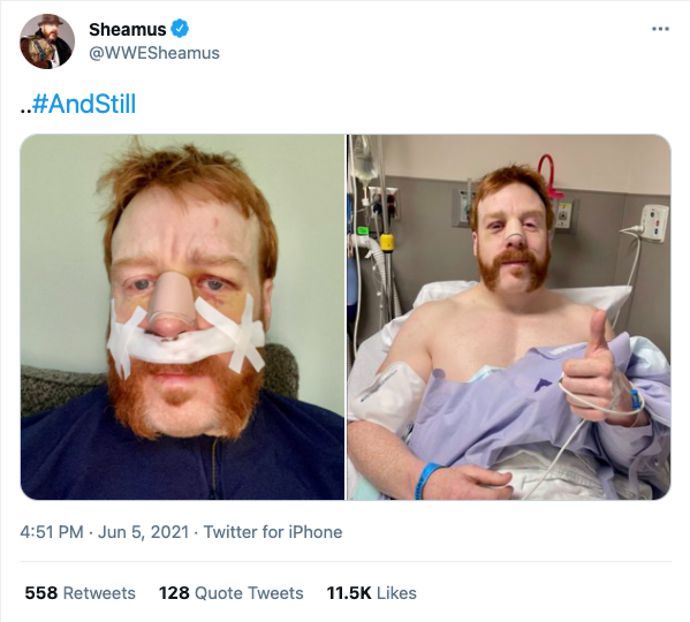Sheamus' nose has been fixed by surgery