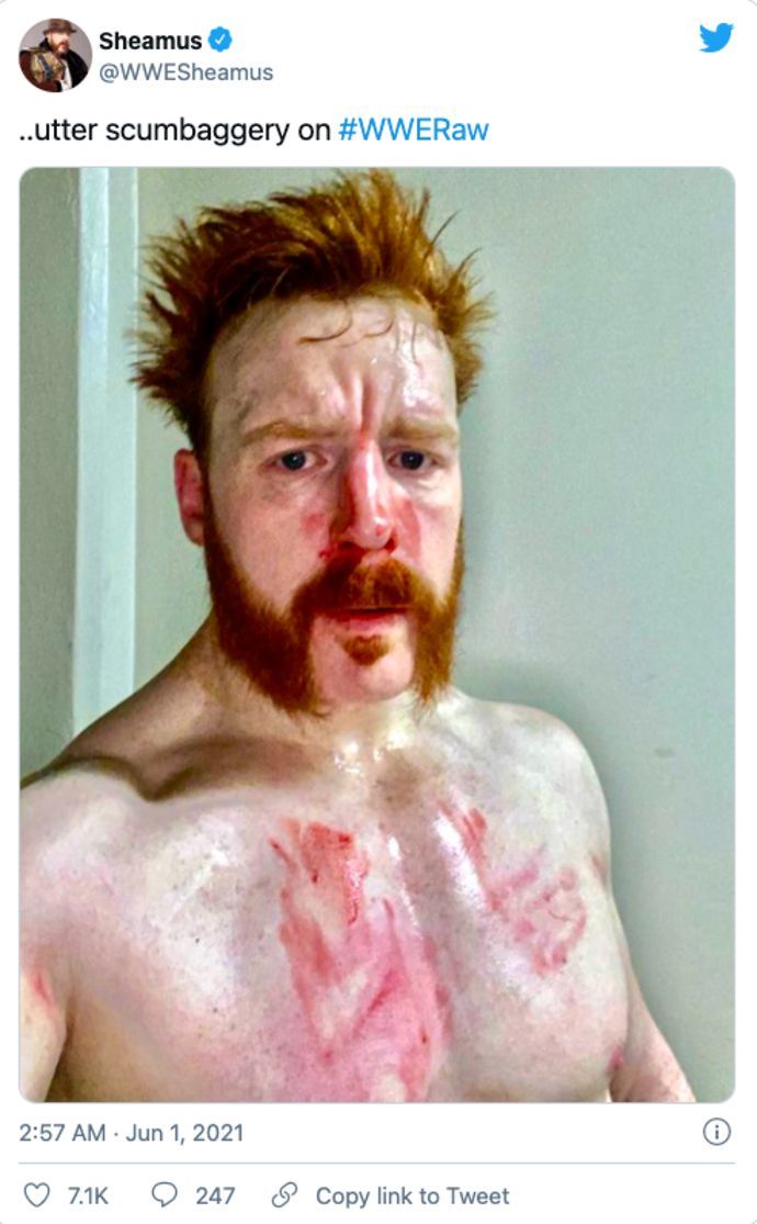 Sheamus was battered on RAW this week