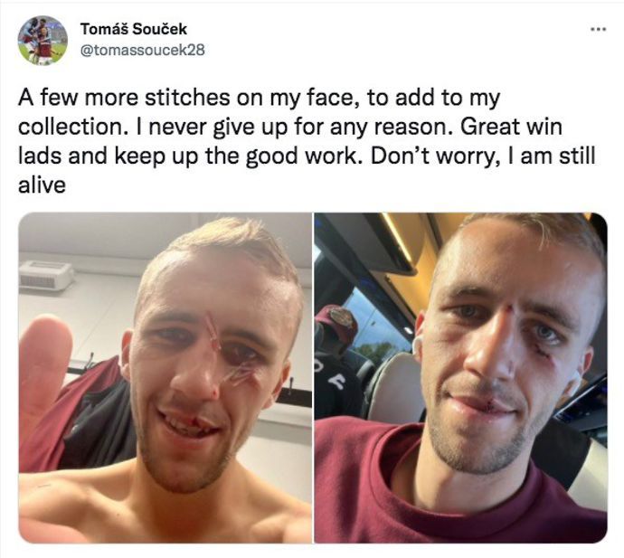 Tomas Soucek's face: West Ham star suffers facial injury from Salomon ...