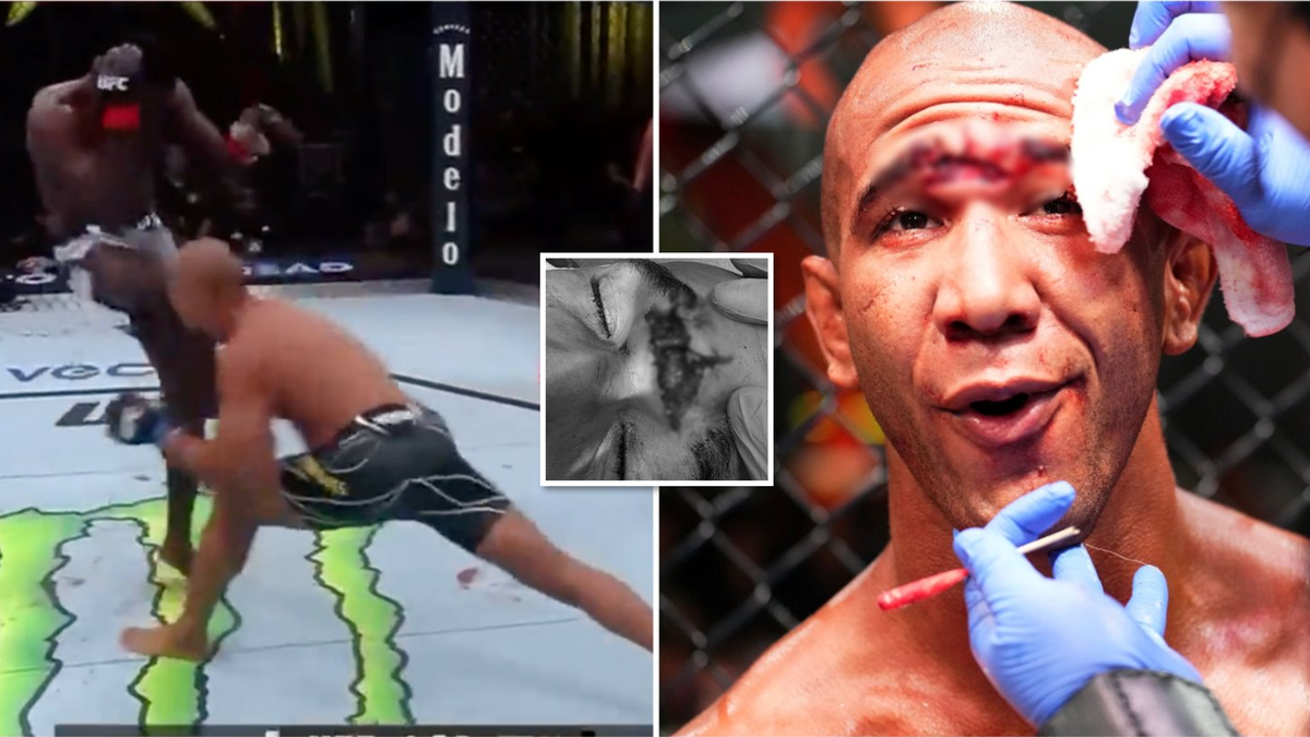 UFC's worst injuries: Gregory Rodrigues' gruesome cut is hard to look at