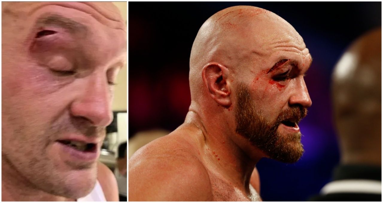 Cutwoman Issues Worrying Update on Tyson Fury's Injury Ahead of Usyk Fight