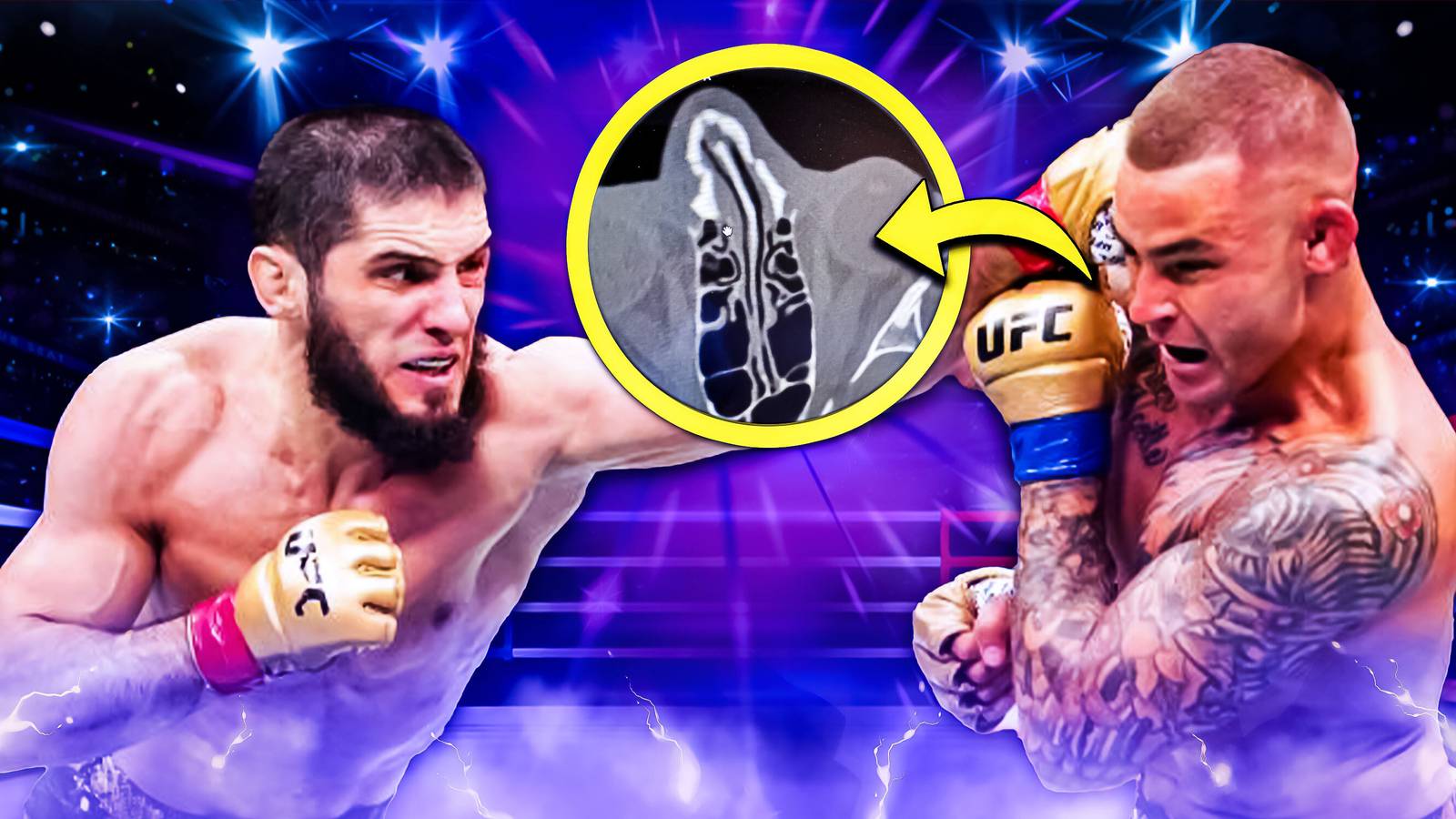 Dustin Poirier's X-Ray of Broken Nose & How it Happened at UFC 302