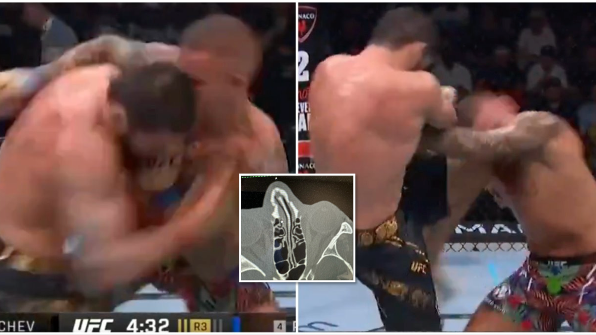 Dustin Poirier's X-Ray of Broken Nose & How it Happened at UFC 302