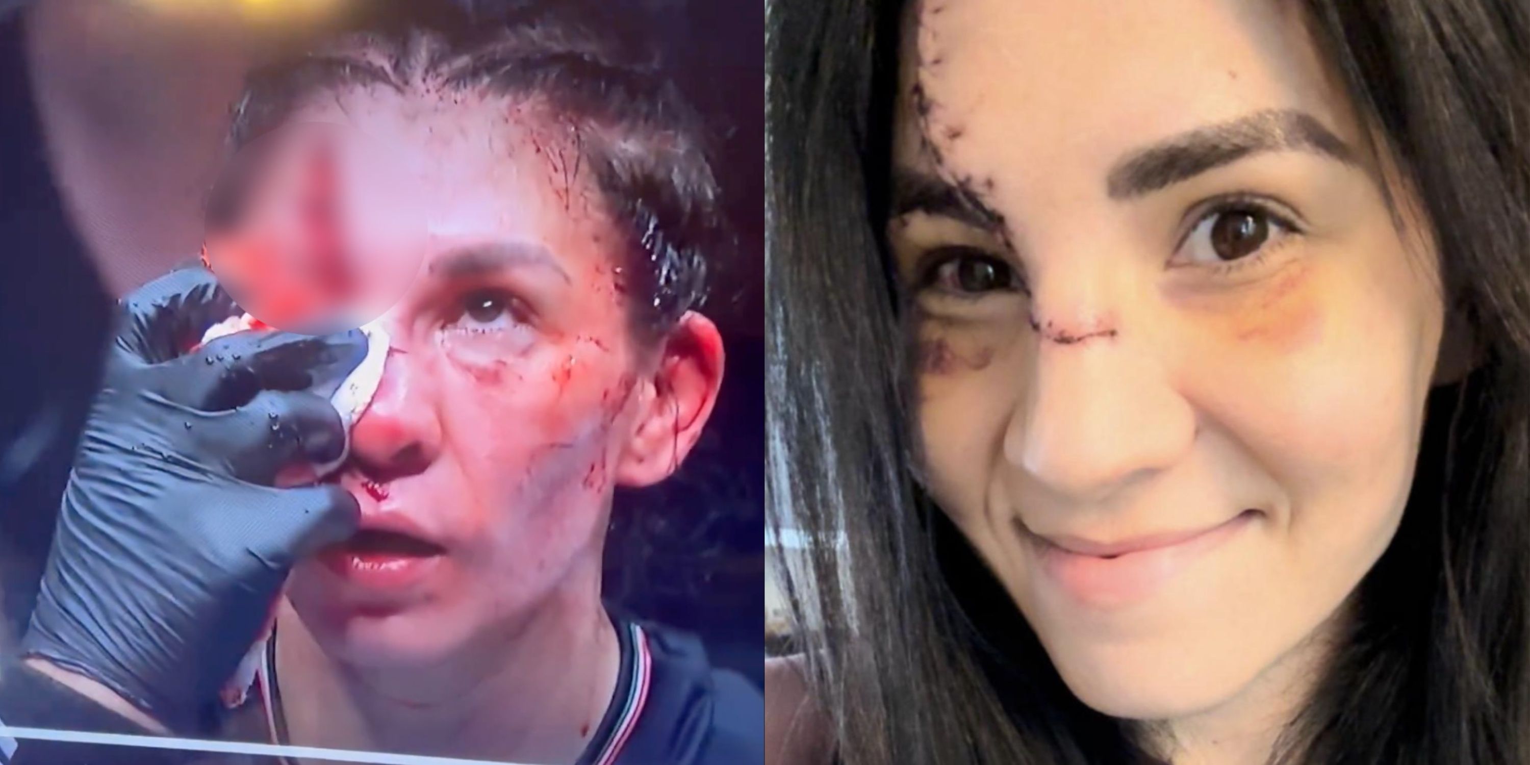 Irene Aldana's Face One Week After Suffering Horrific Cut at UFC 306