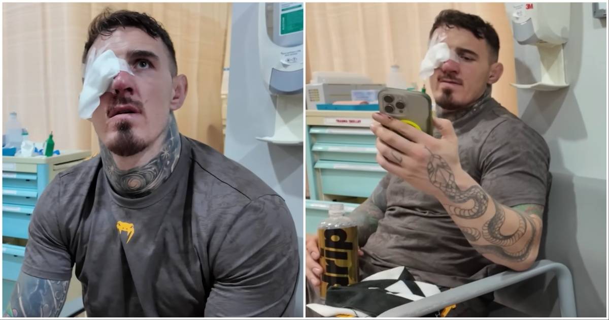 Tom Aspinall's Eye Immediately After Ciryl Gane Eye Poke at UFC 321