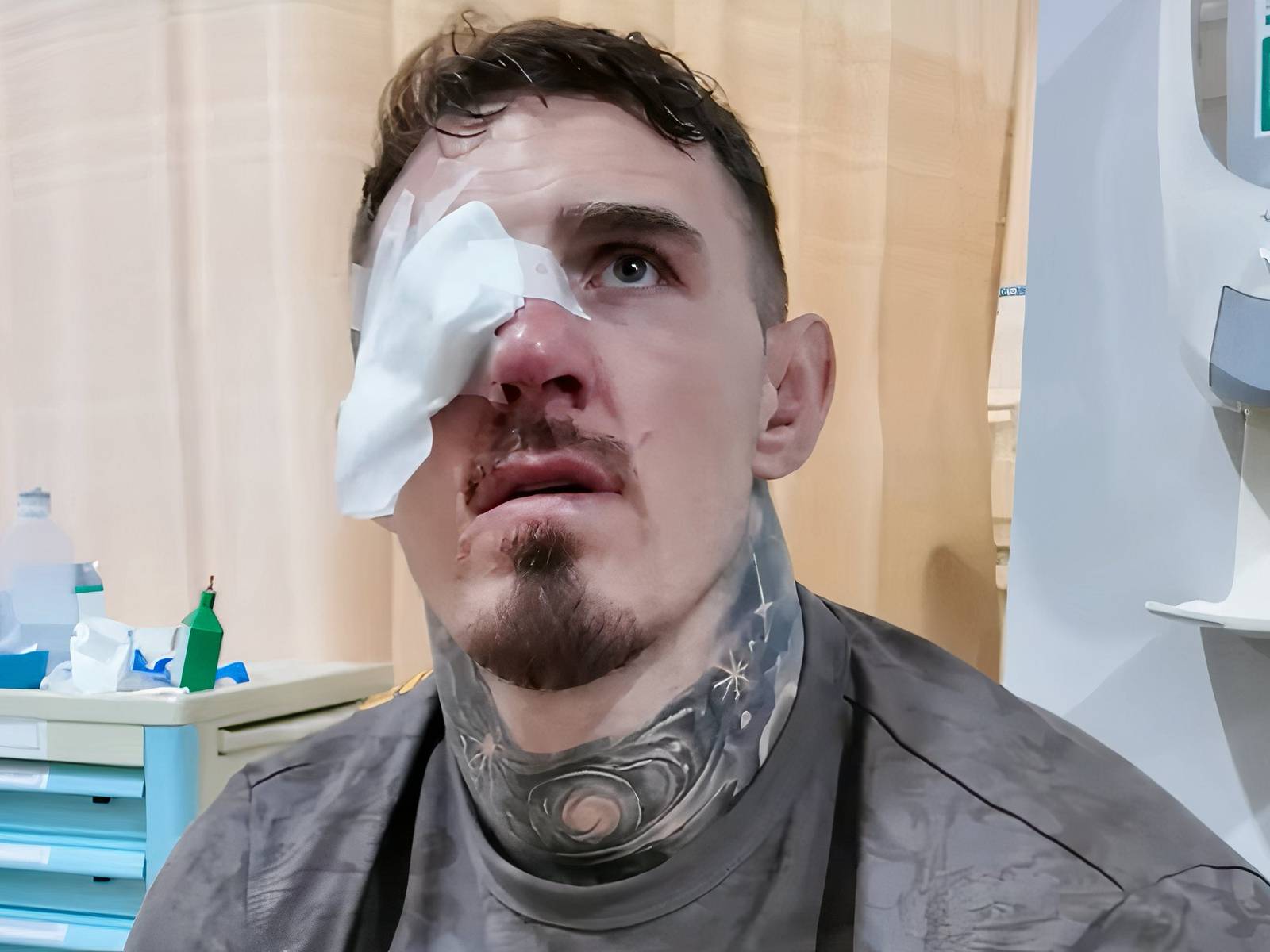 Tom Aspinall occhio bendato dopo chirurgia