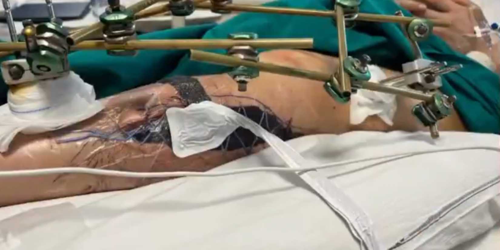 Lindsey Vonn's leg
